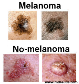 melanoma