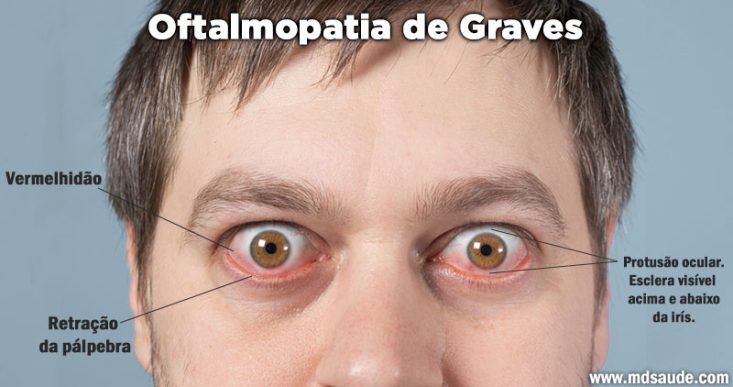 Oftalmopatia de Graves