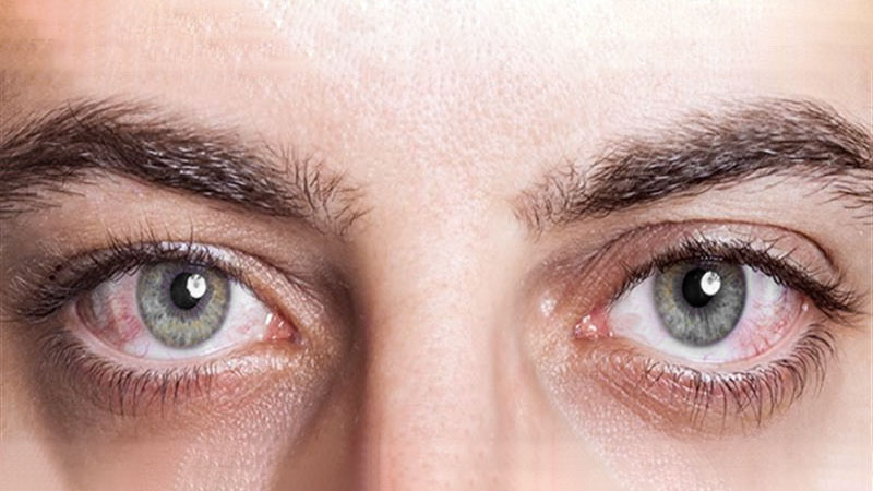 Olhos secos e avermelhados nas áreas em contato com o ar