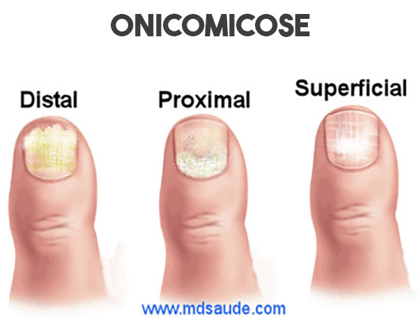 Tipos de onicomicose