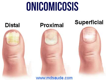 Onicomicosis