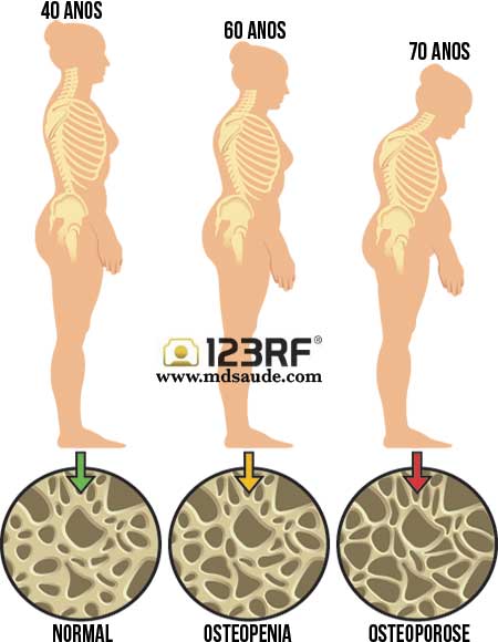 O que é a osteoporose