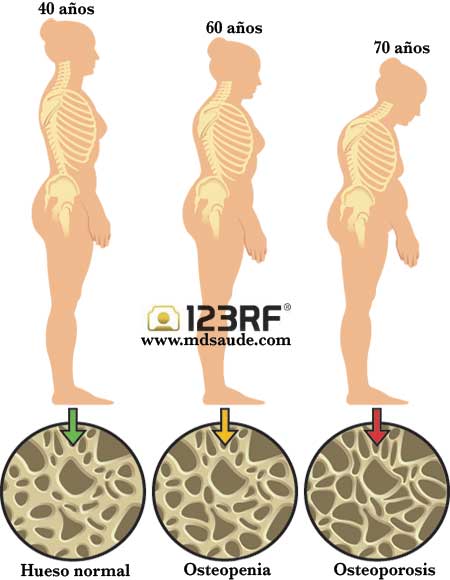 Osteoporosis y osteopenia