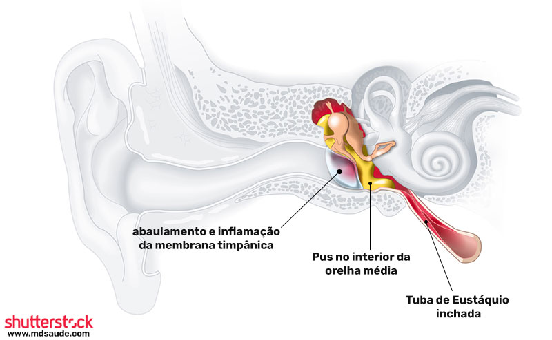 Otite média com pus