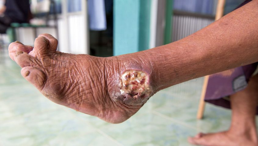PÉ DE CHARCOT E ÚLCERA INFECTADA - foto de pé diabético