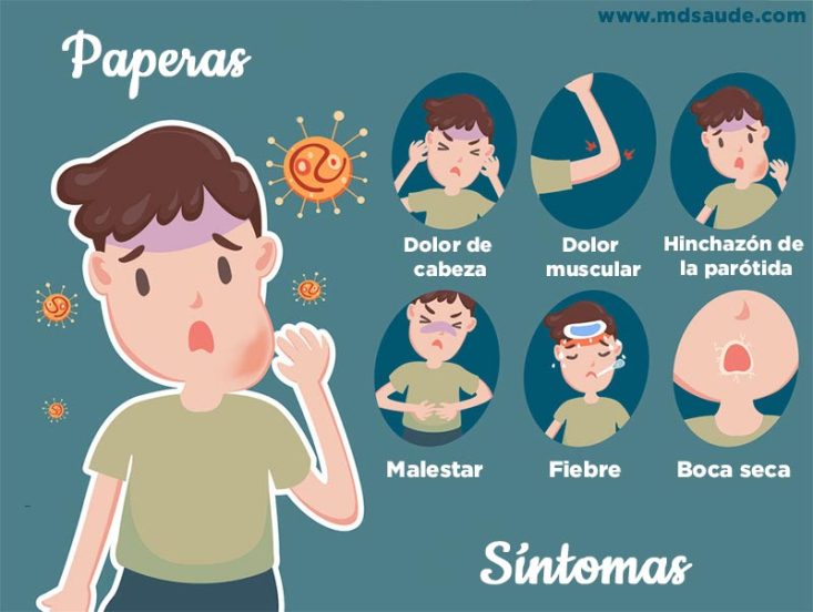 Principales síntomas de las paperas