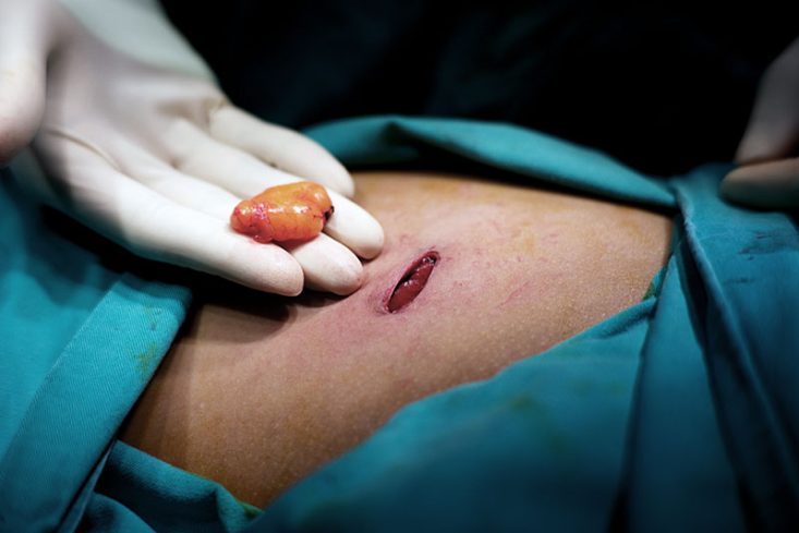 Pequeno lipoma removido cirurgicamente