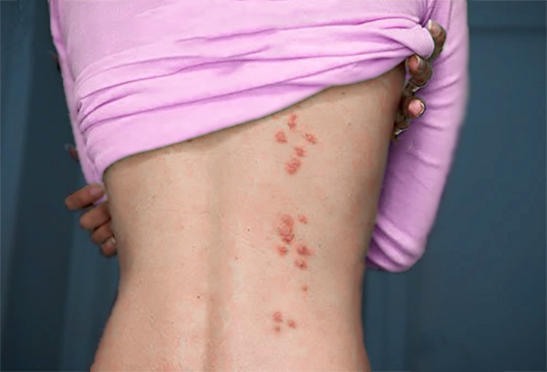 Multiple bedbug bites in the shape of a line