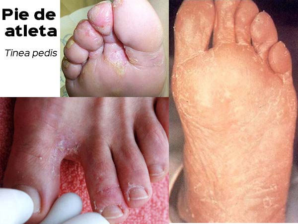 Hongos en los pies