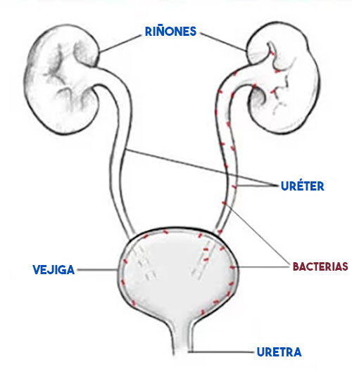 Pielonefritis