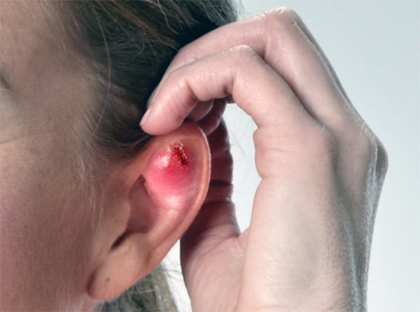 Infecção da cartilagem da orelha pelo piercing