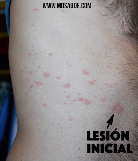Placa heráldica y lesiones hijas