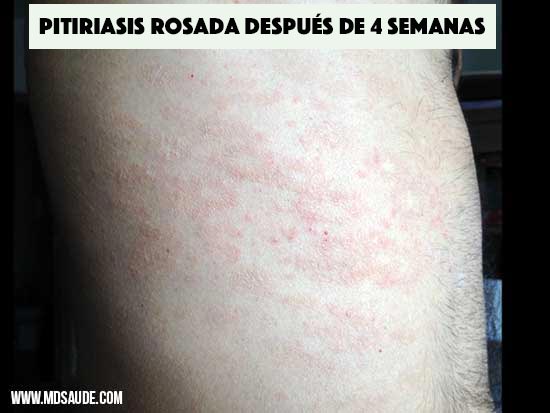 Pitiriasis rosada después de 4 semanas