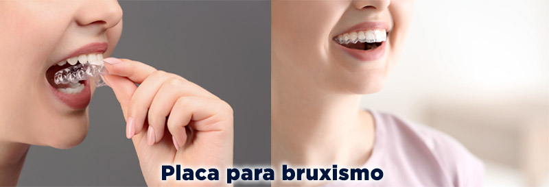 Placa para tratar bruxismo