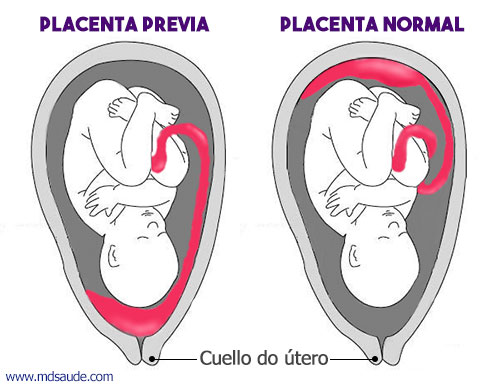 Placenta previa