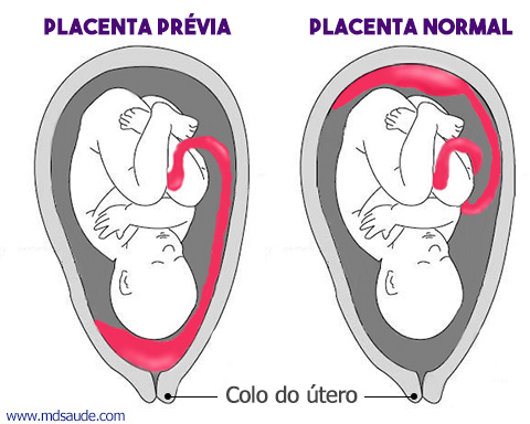 Placenta prévia
