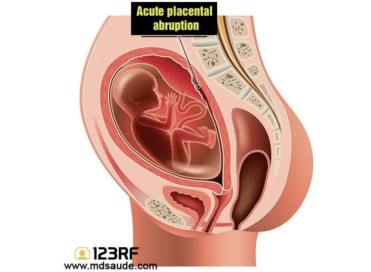 Placental Abruption