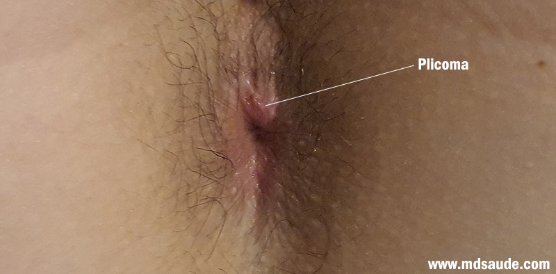 Plicoma o pliegues anales