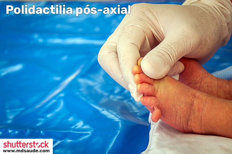 Foto da síndrome de Patau: polidactilia pós-axial.