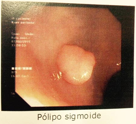 Pólipo