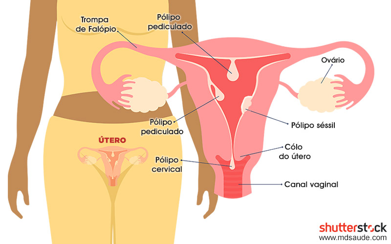 Pólipos endometriais