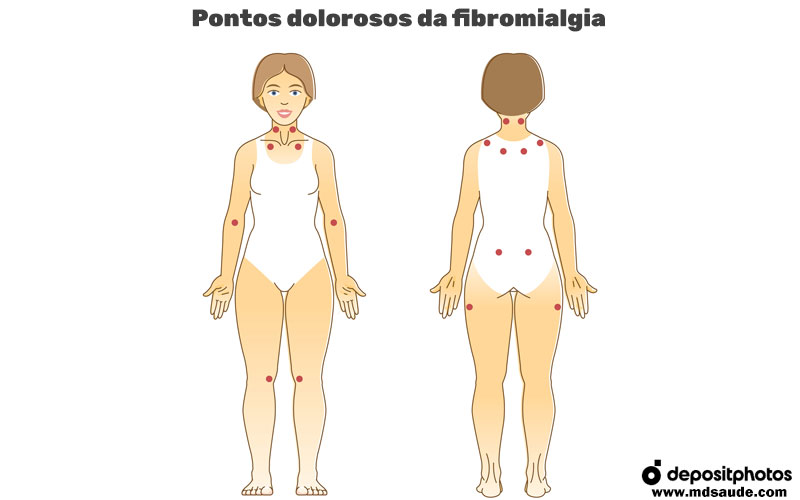 Fibromialgia