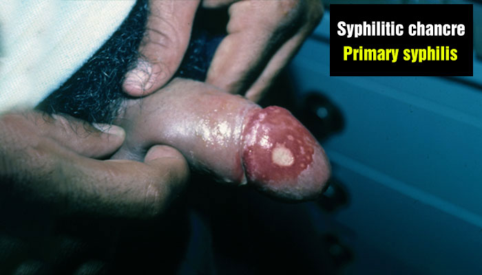 Syphilitic chancre on the penis