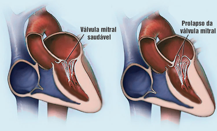 Prolapso da válvula mitral
