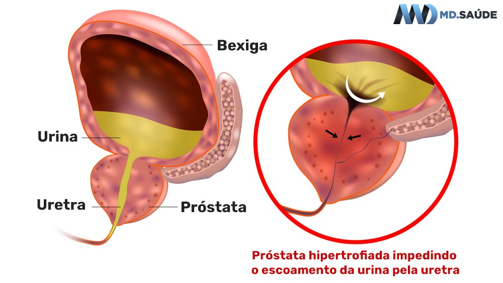 Hipertrofia da próstata