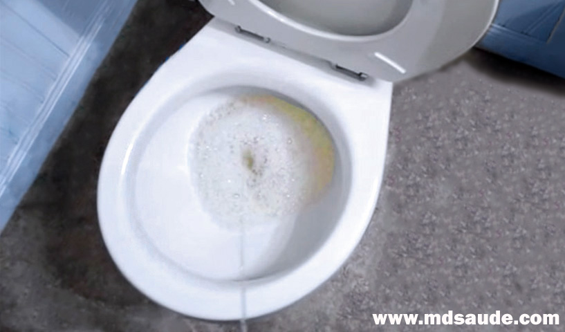 Vaso sanitário com espuma na urina provocada por proteinúria.