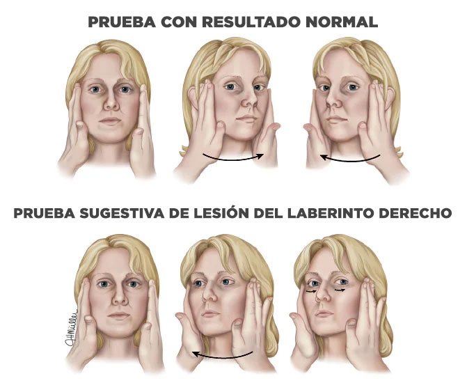 prueba de impulso cefálico