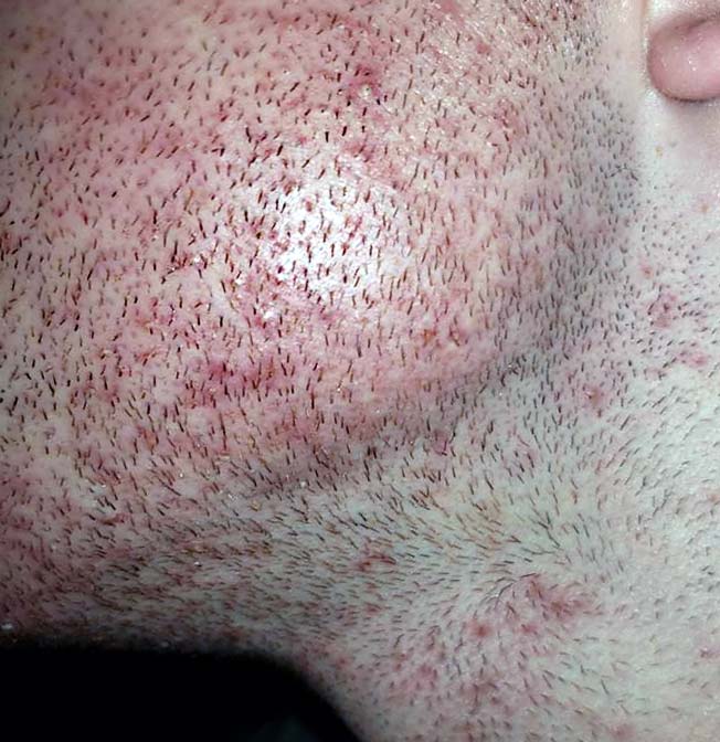 Pseudofoliculite na barba