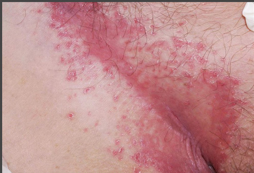 Psoríase invertida