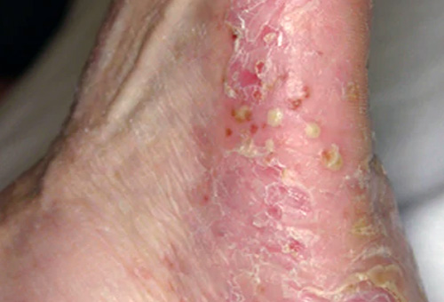 Psoríase pustulosa