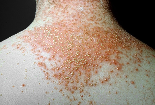 Psoríase pustulosa