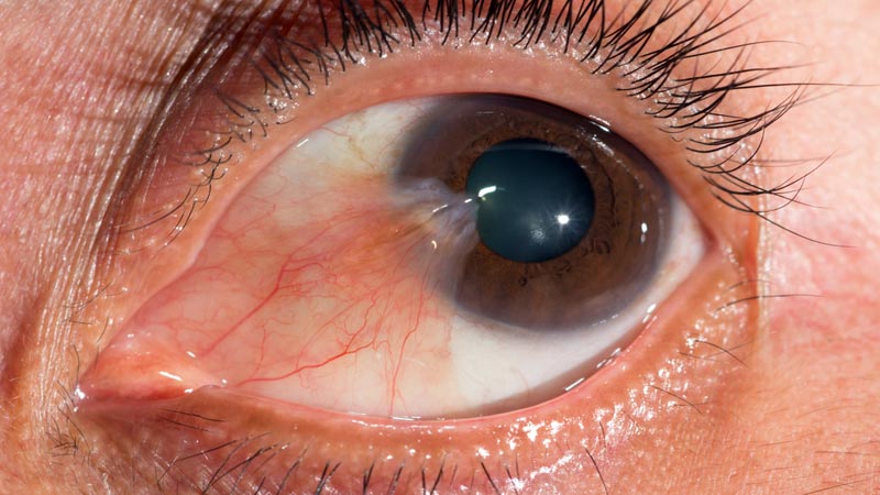 Pterígio - tecido conjuntival em formato de triângulo na parte do olho mais próxima do nariz