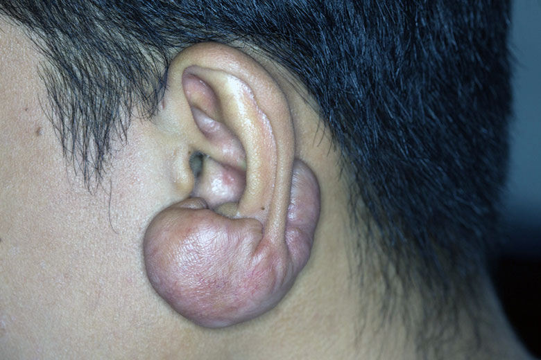 Queloide orelha