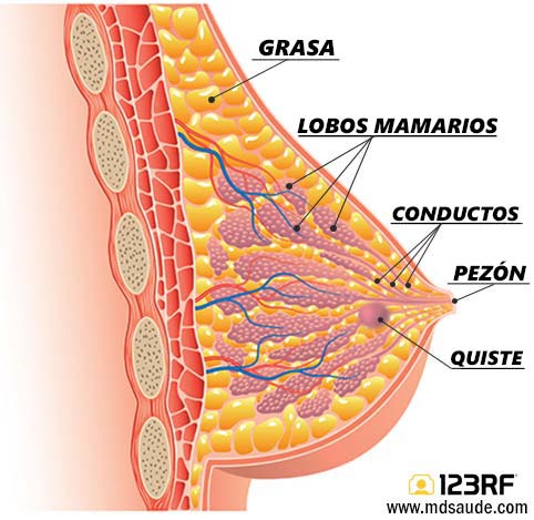 Quiste de mama