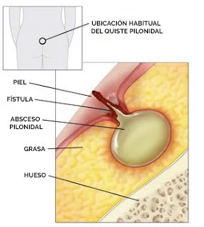 Quiste pilonidal