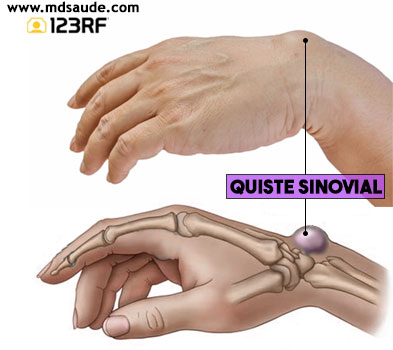 Quiste sinovial