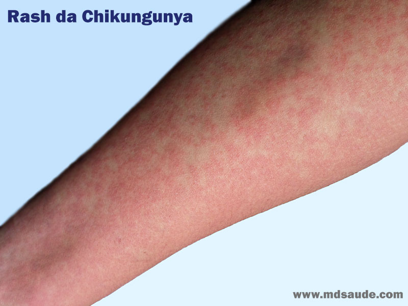 Erupção cutânea em paciente com Chikungunya