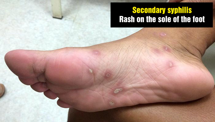 Rash on the sole of the foot