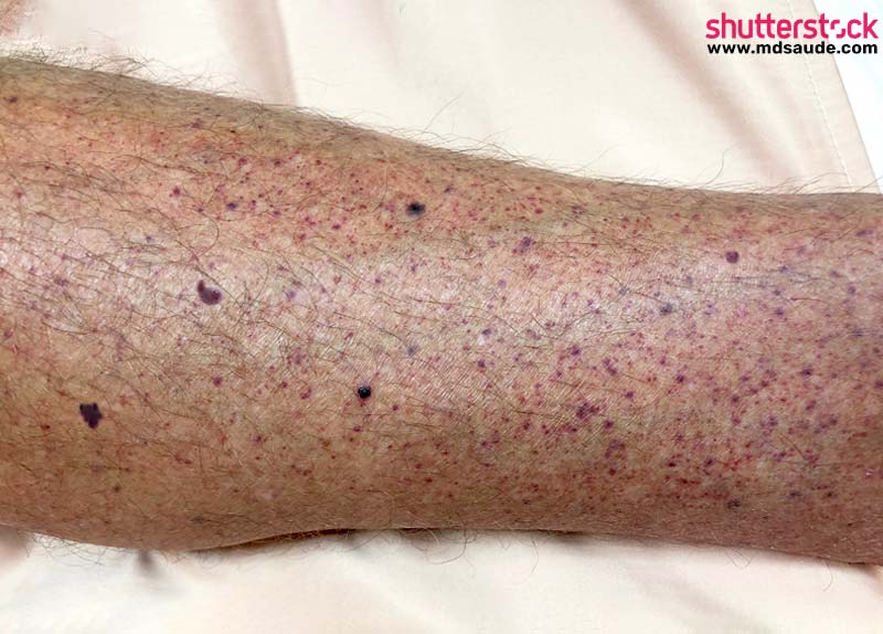 Rash da meningite meningocócica