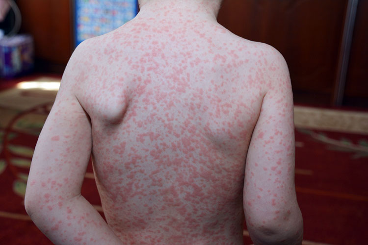 Rash da mononucleose
