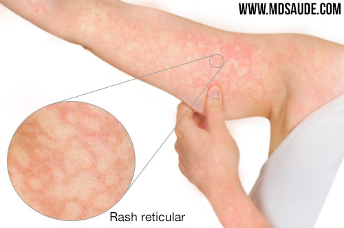 Parvovírus - rash do eritema infeccioso