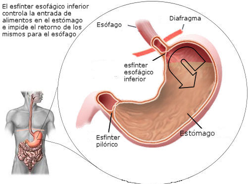 Reflujo gastroesofágico