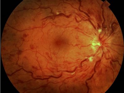 retinopatia hipertensiva