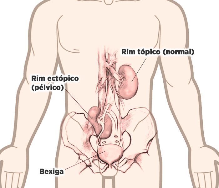 Rim ectópico simples (rim pélvico)