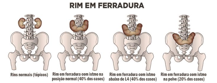 Rim em ferradura