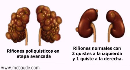 Diferencia entre riñones poliquísticos y riñón con quiste simple
